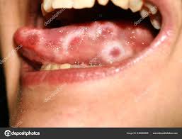 Image result for Puchýře na jazyku