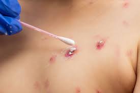 Image result for Skin Ulcer