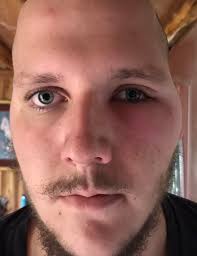 How to treat a bee sting with severe swelling?