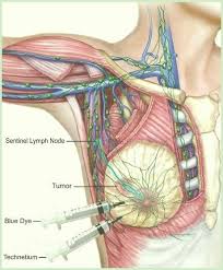 Pin On Breast Cancer