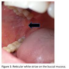 Image result for Labial mucosa