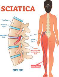Back On Your Feet: Sciatic Pain Relief | Orthopedic Blog | Orthocarolina