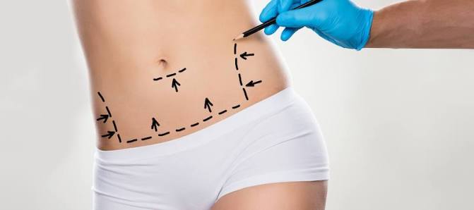 Tummy tuck in Mexico