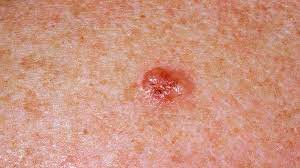 The possible causes of white spots on legs include: Spotting The Signs Of Skin Cancer Everyday Health