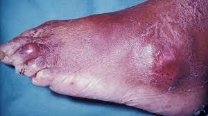 Image result for gout symptoms toe