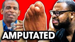 Why Did Deon Sanders lose his toes? Orthopedic Surgeon Explains....