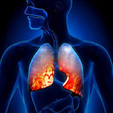Pada akhirnya, dapat terjadi gagal napas, gagal jantung, atau komplikasi lainnya. Penyebab Munculnya Penyakit Paru Paru Basah Atau Pneumonia Rumah Sakit Uns
