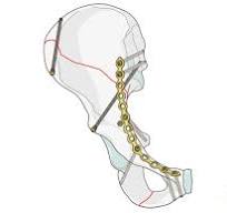 ORIF through ilioinguinal approach for Anterior column