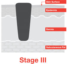 Painless, rubbery swelling of lymph node. Stage 3 Melanoma Melanoma Research Alliance