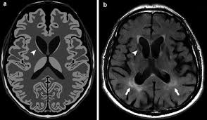 Nov 29, 2020 · huntington's disease is a neurological condition. Huntington S Disease Springerlink