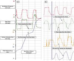 Assessment Of Endotracheal Tube Placement In Newborn Infants