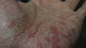 Dyshidrotic Eczema Overview Causes Diagnosis And Pictures Eczema Treatment Eczema Symptoms Eczema On Hands