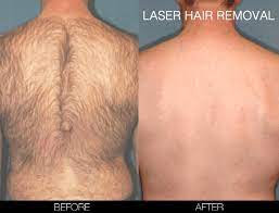 Best women's single area laser hair removal prices in charlotte half back. Laser Hair Removal Procedure In Toronto Spamedica