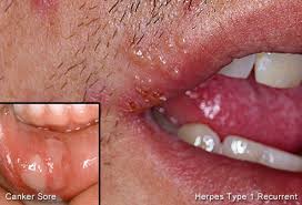 Always cover your mouth when you sneeze or cough to reduce the chances of spreading the virus to someone else. Cold Sores Pictures Of What They Look Like