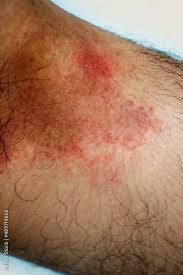Image result for sore skin in the groin area