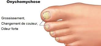 Comment Se Debarrasser Des Ongles De Pied Jaune Bonheur Et Sante