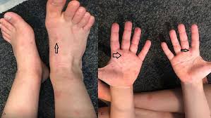 Image result for Beau lines feet