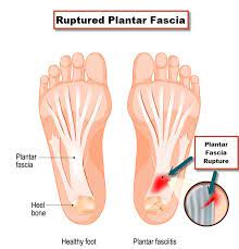 Plantar Fasciitis Or Plantar Fascia Tear
