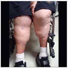 Image result for Lipodermatosclerosis