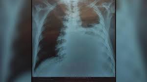 Nah, berarti ini adalah waktu yang tepat untuk membaca ramalan zodiak hari valentine. Humas Bnpb Sutopo Jalani Penyedotan Cairan Di Paru Paru