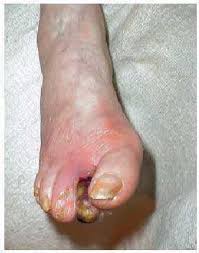 Symptoms may include a change in skin color to red or black, numbness, swelling, pain, skin breakdown, and coolness. El Pie Diabetico Medicina Integral