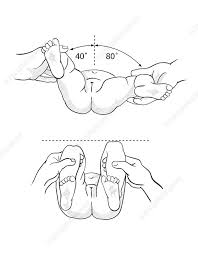 Image result for Galeazzi Sign