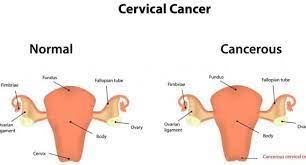 The uterus remains after this procedure, so it may be possible to become pregnant, if you choose. Cervical Cancer Health Tips Cervical Cancer Health Articles Health News Thehealthsite Com