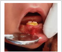 Image result for Neonatal Teeth