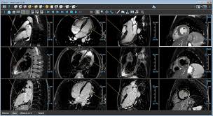Image result for Cardiac MRI