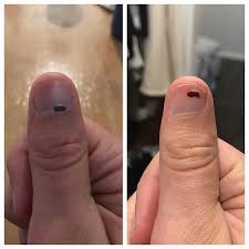 For a blister that has popped wash the area with warm water and gentle soap. Joe Penna On Twitter Back In January I Hit My Finger And Got A Blood Blister If You Think I Haven T Been Getting A Timelapse Of This You Don T Know Me