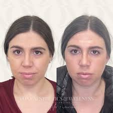 Bright-Eyed & Refreshed! ✨ This gorgeous transformation was achieved with  just 1 syringe of Restylane under the eyes + a little tox to lift and even  out the brows! 😍 👀 Say