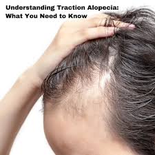 Image result for Alopecia
