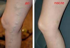 * kudis di buku lali yang sukar baik. Varokositi Rawatan Gejala Ekstrem Yang Lebih Rendah Tapak Mengenai Vena Varikos