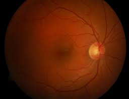 Learn more about the healthy people 2020 vision topic area. Saving Sight Using Ai To Diagnose Diabetic Eye Disease