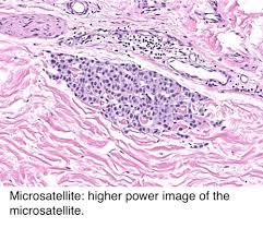 Pathology Outlines Pathologic Tnm Staging Of Melanoma Of