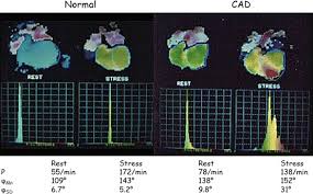 Image result for Nuclear Ventriculogram
