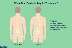 A lousy neck or forehead position causes your body to deposit fat in specific places around the middle of the riff this fat creates a buffalo hump in the back of the neck. Scoliosis Overview And More