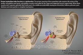 Ear Pain, Ear Fullness, Sound Sensitivity, Tinnitus, Meniere's Disease And  Hearing Problems Caused By Neck Instability – Caring Medical Florida