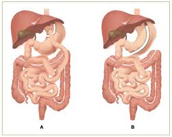 Nutrients Free Full Text Bariatric Surgery In Obesity Effects On Gut Microbiota And Micronutrient Status Html
