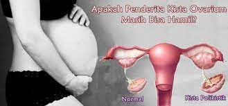 Apakah Penderita Kista Ovarium Masih Bisa Hamil Jangan Pernah Putus Asa Tidak Semua Penyakit Kista Menyebabkan Kemandulan Kok Yuk Ke Hamil Perasaan Jenis