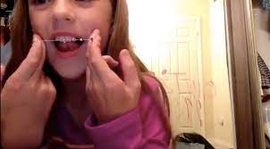 Teens Are Making And Wearing Fake Braces Attn