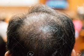 A surgeon removes individual hairs—or a strip of skin with hairs—from one part of your scalp and transplants them to thinning or balding areas. Close Up Of Balding And Thinning Hair Of Man Revealing Scalp Stock Photo Picture And Royalty Free Image Image 91020407