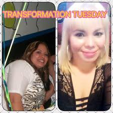 One year after gastric sleeve surgery for weight loss and cancer treatment