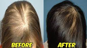 There are many reasons why your hair could be falling out. How To Make Black Seed Oil For Hair Growth Guide To Use