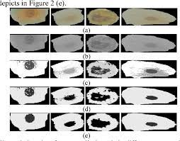 This observation may be due to the facts that people of color with lung cancer are less likely to be diagnosed. Early Detection Of Lung Cancer Based On Sputum Color Image Analysis Semantic Scholar