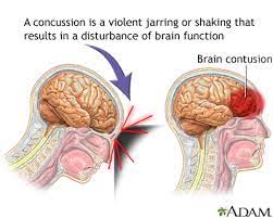 Concussion: Medlineplus Medical Encyclopedia