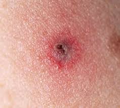 Image result for infected tick bite