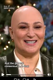 After losing her hair as a teenager, journalist Sarah Vine spent decades  hiding behind a hair system. Now she's taking it off for good, hoping to  normalise a condition that affects far