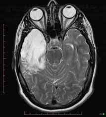 In addition, it was observed in various pathological conditions: Temporal Lobe Atrophy Post Herpes Simplex Encephalitis Radiology Case Radiopaedia Org