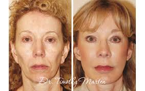 Трансляция VASER-технология в пластической хирургии лица